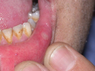 Ağızda Aft Belirtileri ve Tedavisi