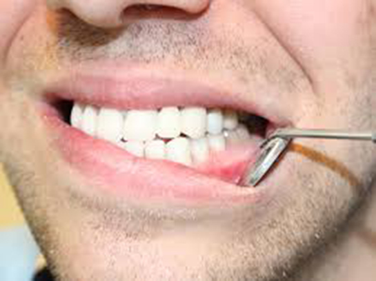 Diş Etinde Aft Belirtileri ve Tedavisi